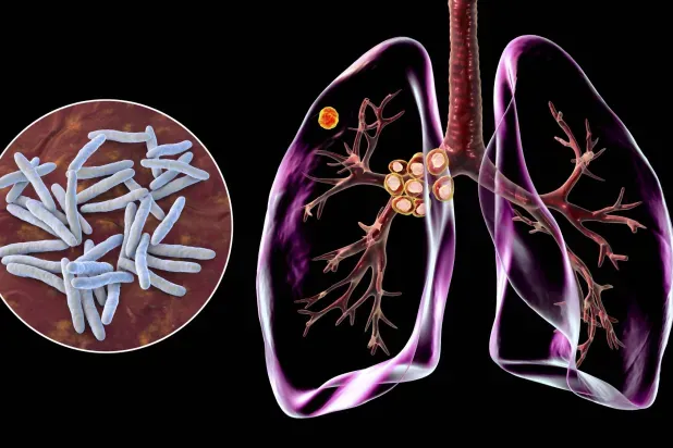 تقنيات التسلسل الجيني تكشف خريطة جديدة لانتشار السل