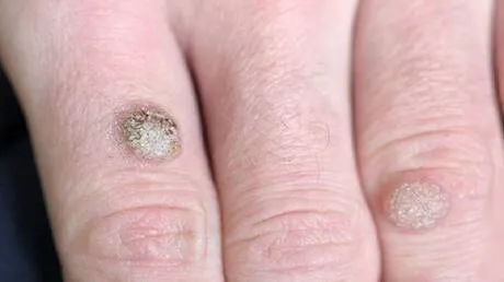 أكثر من 100 سلالة.. فيروس الورم الحليمي البشري بين العدوى الصامتة وخطر الإصابة بالسرطان