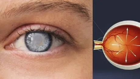 5 أخطاء شائعة في الصيف تضر بصحة العين