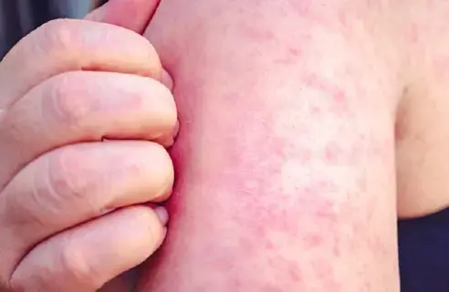 1001 حالة حصبة مؤكدة في أمريكا 1001 حالة حصبة مؤكدة في أمريكا
